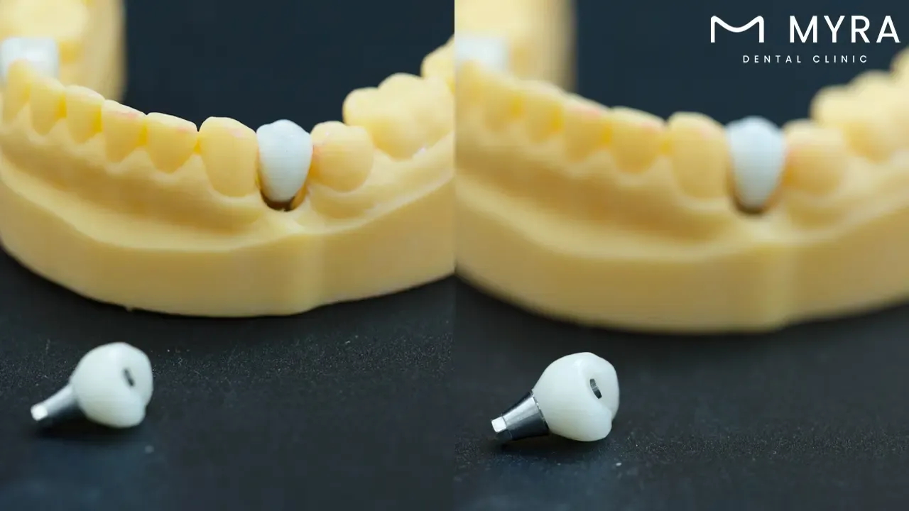 Abutment Installation for Dental Implant.webp